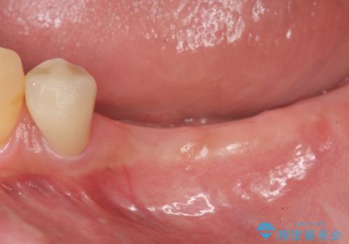 臼歯部の欠損　インプラント補綴の症例 治療前