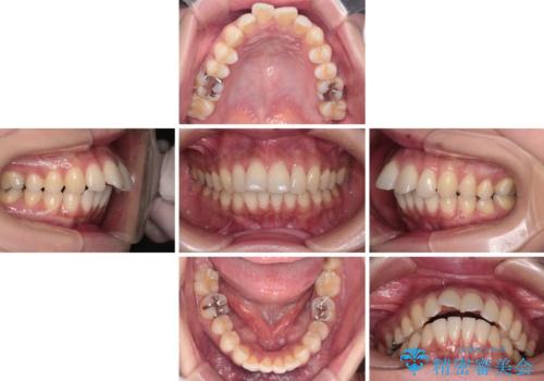 上顎前歯の突出を軽減　インビザラインによる抜歯矯正の治療前