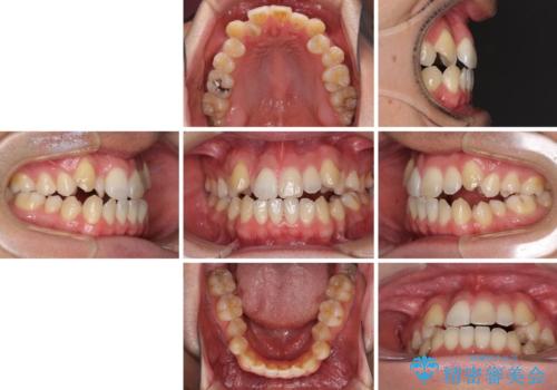 左右の八重歯が気になる ワイヤー装置での咬み合わせ改善の治療前