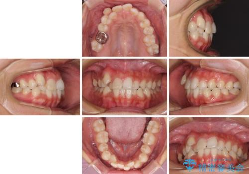 気になる八重歯 目立ちにくいハーフリンガルでの抜歯矯正の治療前