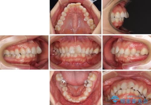 出っ歯と咬み合わせを改善 ワイヤー装置の抜歯矯正の治療前