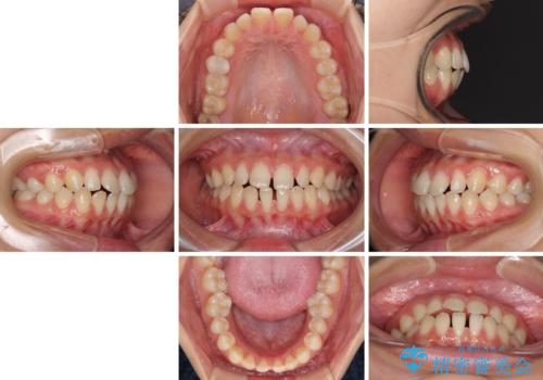 隙間だらけの歯列 インビザラインで改善の治療前