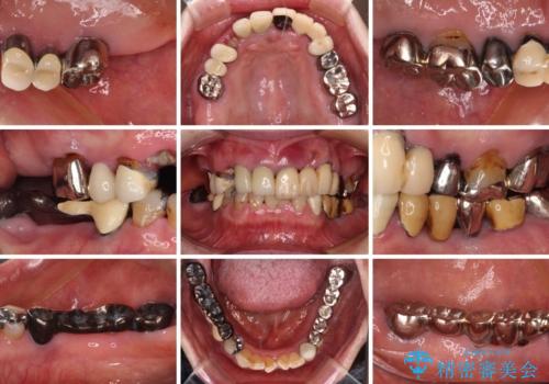 前歯をきれいにしたい インプラントや部分矯正を用いた総合歯科治療の治療前