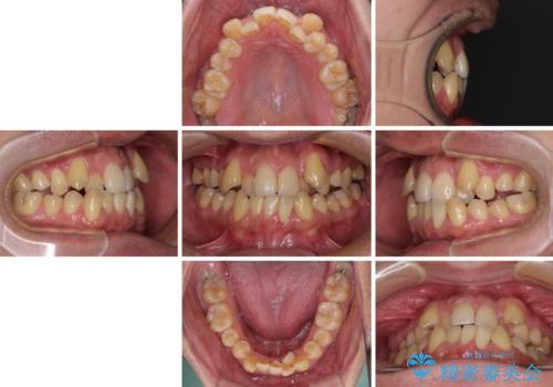 八重歯とクロスバイト 目立たないワイヤー装置で矯正治療の治療前