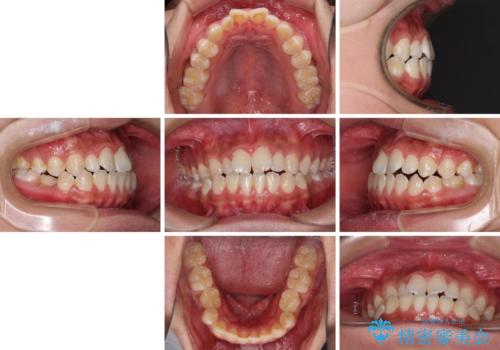 口元の突出感を改善　受け口傾向の咬み合わせの抜歯矯正の治療前