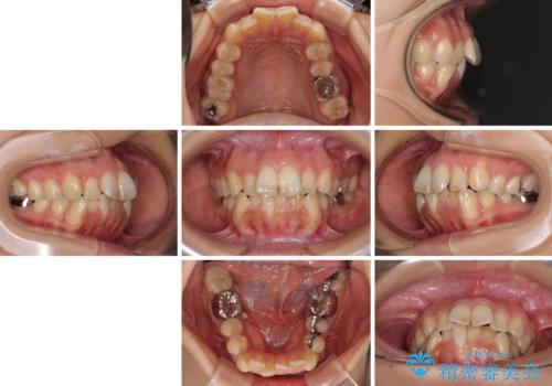 デコボコと口元の突出感 ハーフリンガルでの抜歯矯正の治療前