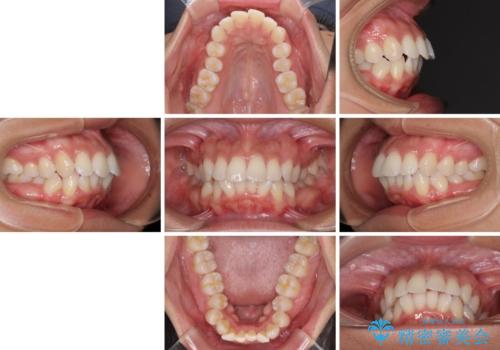 抜歯矯正で唇を閉じやすく 目立たないワイヤー装置の治療前