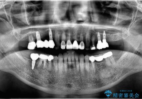【インプラント】 他院で入れた被せ物が取れたの治療後