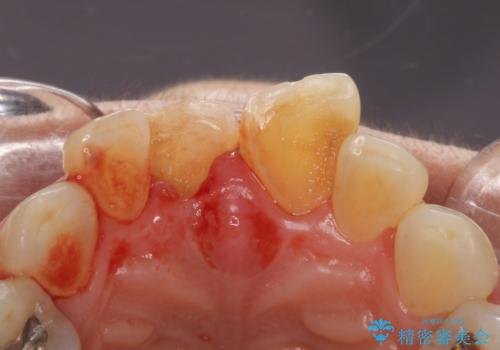 転んで前歯を折った 歯を抜かない治療の治療前