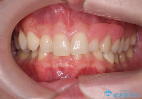 前歯に目立たないノンクラスプデンチャーを作りたいの治療後