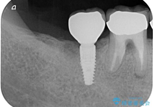 【インプラント】 他院で入れた被せ物が取れたの治療後