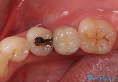 銀の詰め物 セラミックへのやり替えの治療前