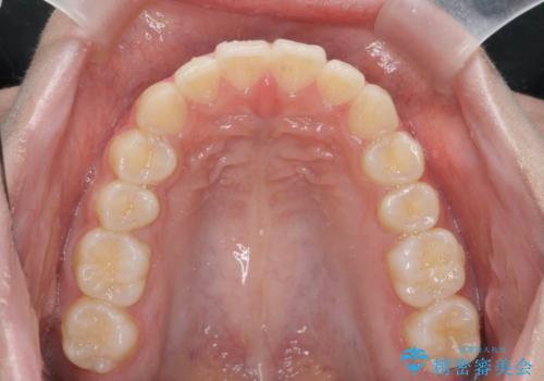 矯正治療を途中でやめてしまった、途中からの治療希望の治療後