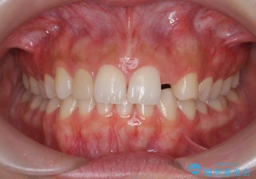 前歯が出っ歯ですきっ歯　抜かずに前歯を見た目良くの治療中