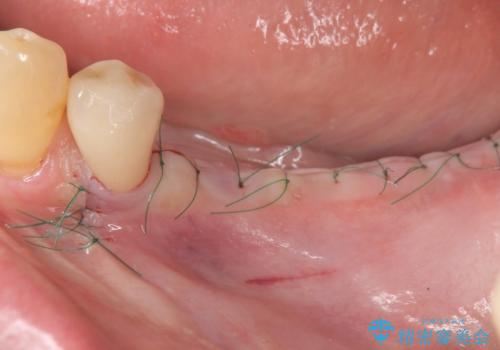 臼歯部の欠損 インプラント補綴の治療中