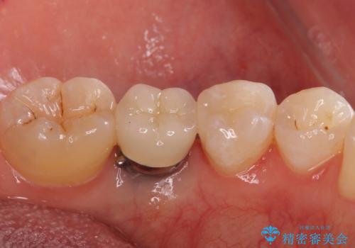 銀の詰め物 セラミックへのやり替えの治療後