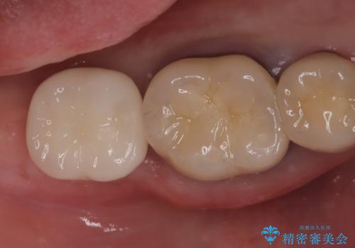 【インプラント】 他院で入れた被せ物が取れたの治療後