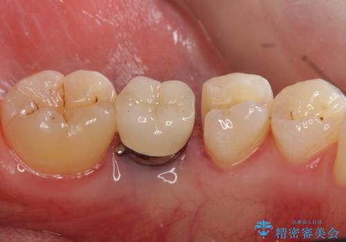 銀の詰め物 セラミックへのやり替えの治療中