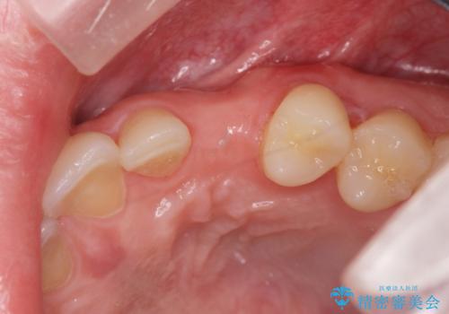 前歯に目立たないノンクラスプデンチャーを作りたいの治療前