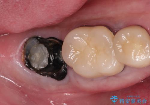 【インプラント】 他院で入れた被せ物が取れたの治療前