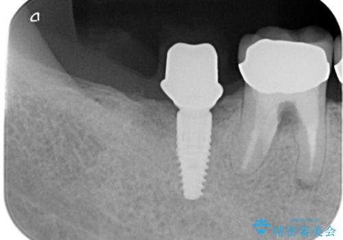 【インプラント】 他院で入れた被せ物が取れたの治療中