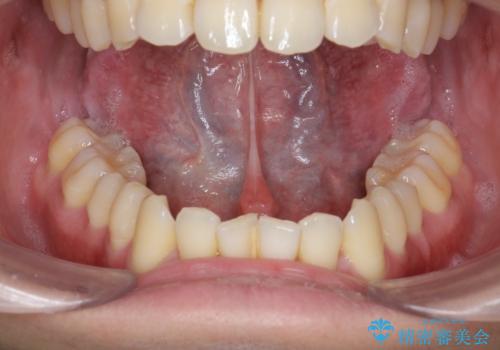 滑舌の改善をしたいの治療前