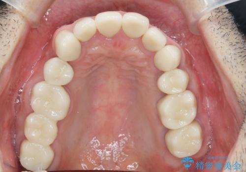 全ての歯を治療したいの治療後