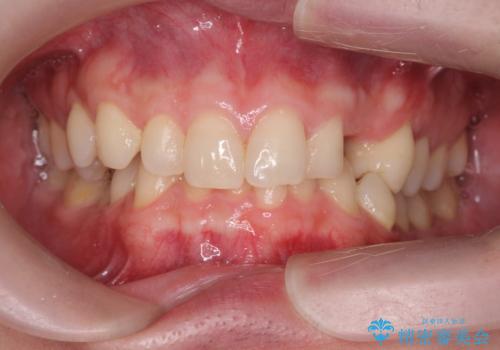 前歯に目立たないノンクラスプデンチャーを作りたいの治療前