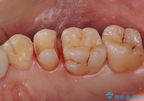 銀の詰め物を白くしたい セラミックインレーでの治療の治療中