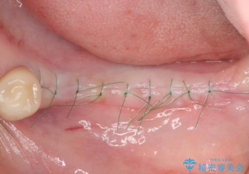 臼歯部の欠損 インプラント補綴の治療中