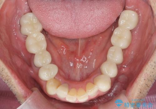 全ての歯を治療したいの治療後