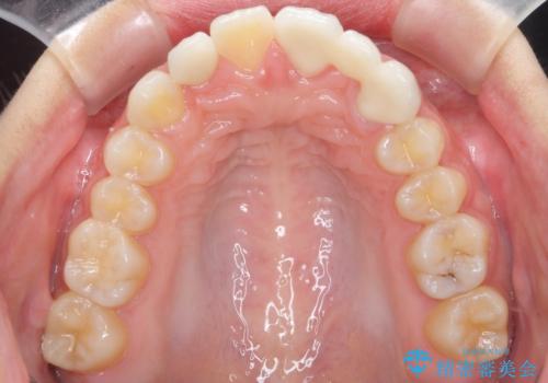 前歯が出っ歯ですきっ歯　抜かずに前歯を見た目良くの治療後