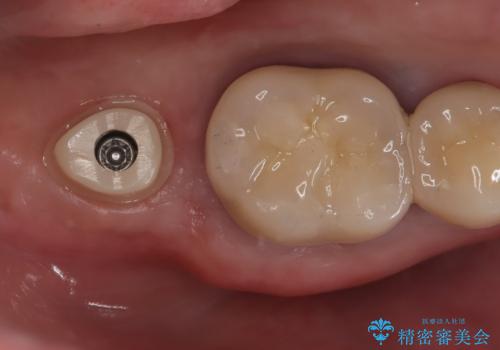 【インプラント】 他院で入れた被せ物が取れたの治療中