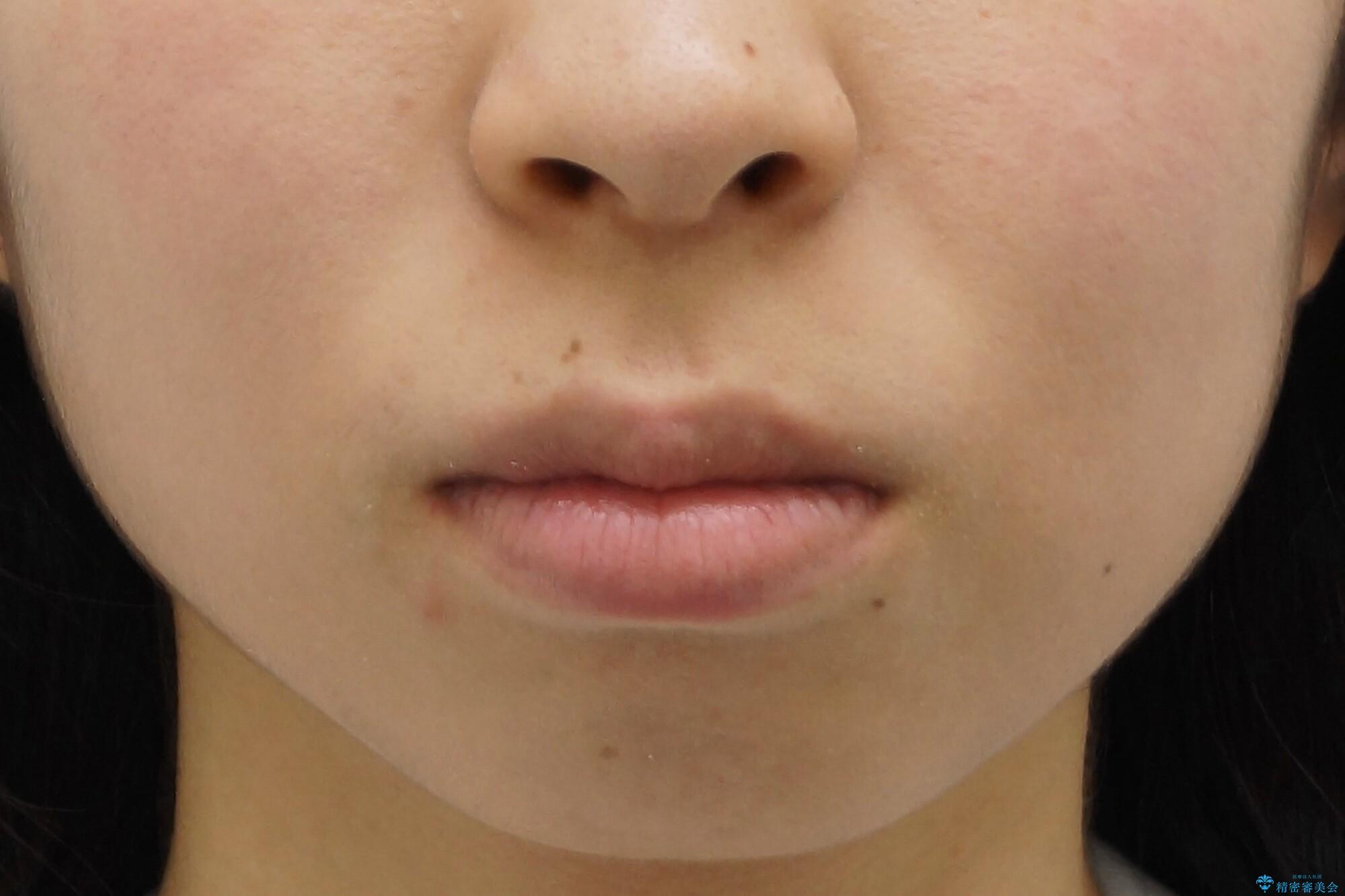 八重歯 歯並びのがたつきの治療前(顔貌)