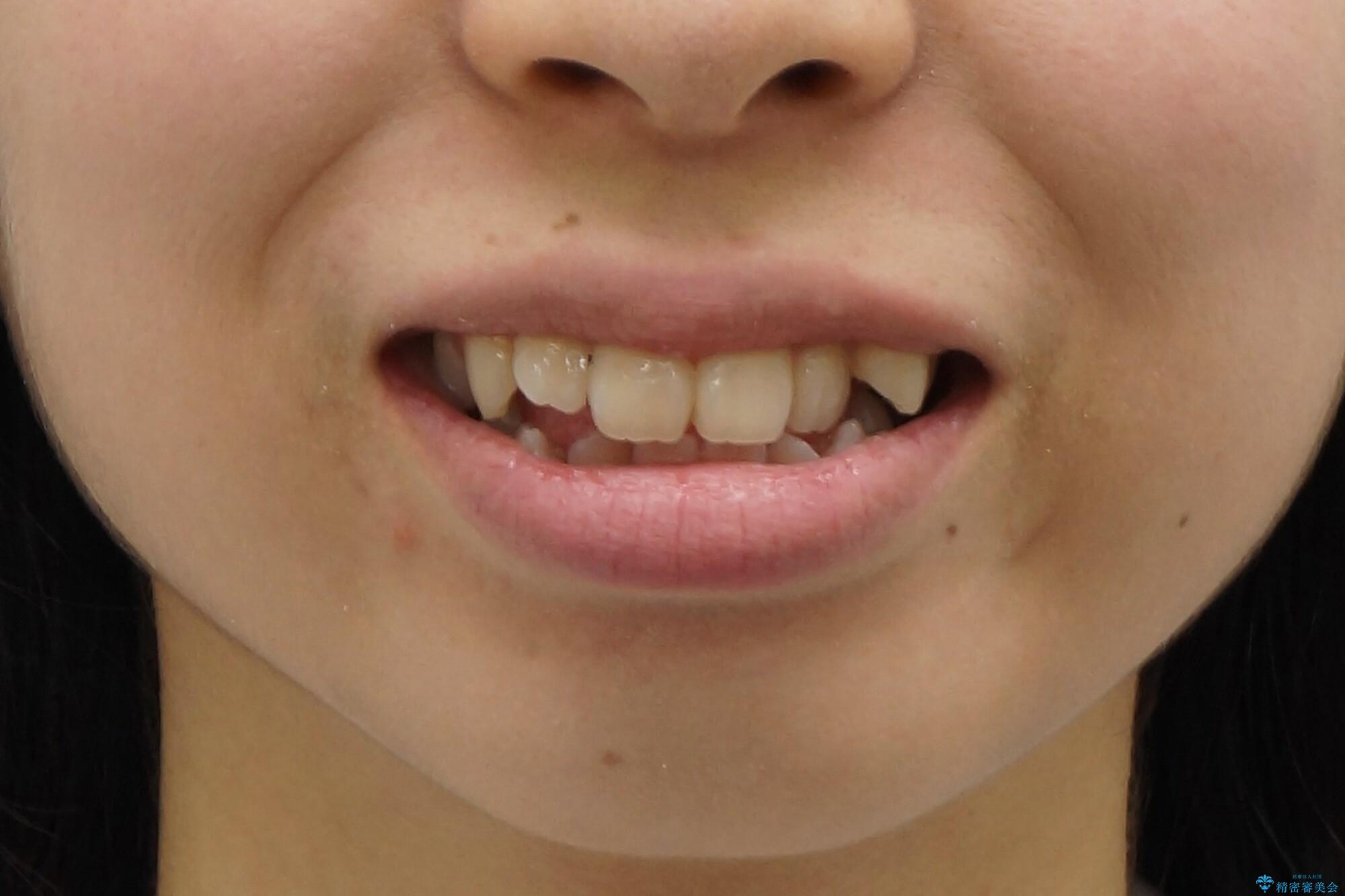 八重歯　歯並びのがたつきの治療前（顔貌）