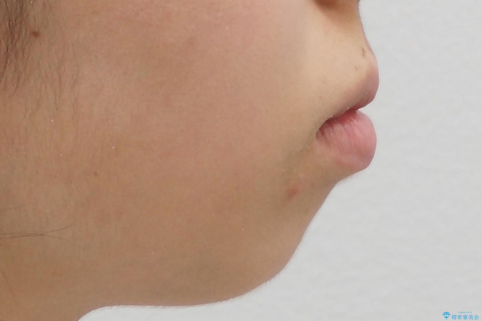 八重歯 歯並びのがたつきの治療前(顔貌)