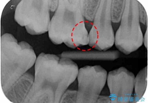 歯と歯の間の虫歯　セラミックインレーでの治療