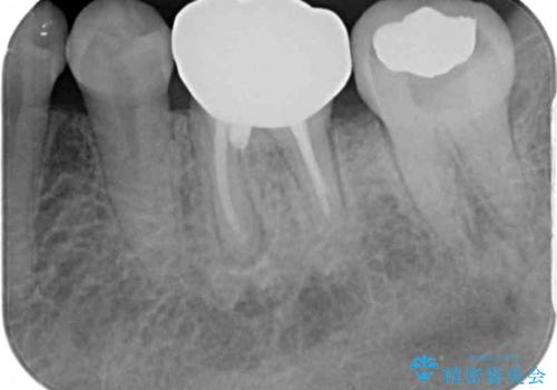 むし歯で歯茎から血が出てくる オールセラミッククラウンでの補綴治療の治療後