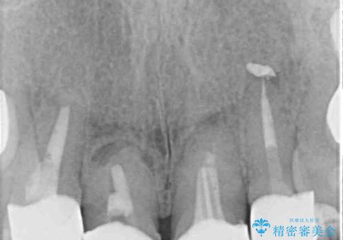 仮歯のまま放置した前歯 オールセラミッククラウンで自然な前歯にの治療後