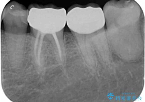 目立つ銀歯を白くしたいの治療後