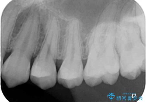 歯と歯の間の虫歯 セラミックインレーでの治療の治療後