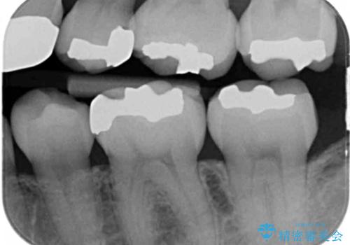 銀歯を白くしたい　セラミックインレーでのやり替えの治療前