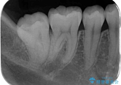 奥歯の黒ずみが気になる　セラミックインレーでの治療の治療後