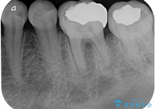 むし歯で歯茎から血が出てくる オールセラミッククラウンでの補綴治療の治療前