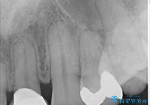 銀の詰め物を白くしたい セラミックインレーでの治療の治療前