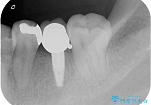 銀の詰め物 セラミックへのやり替えの治療前