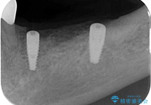 臼歯部の欠損 インプラント補綴の治療中