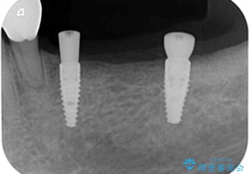 臼歯部の欠損 インプラント補綴の治療中