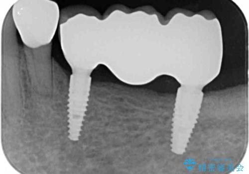 臼歯部の欠損　インプラント補綴の治療後