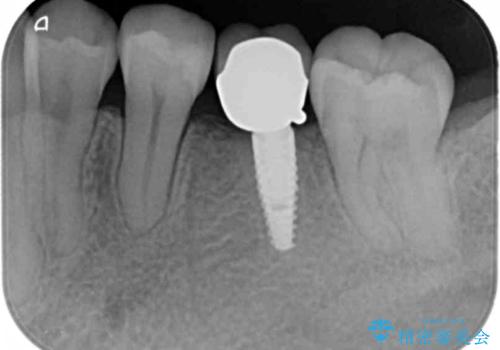 銀の詰め物 セラミックへのやり替えの治療後
